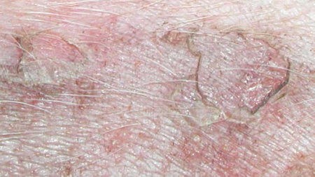 kožne bolezni psov - slike: folikulitis